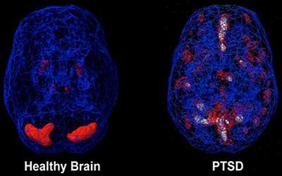تاثیر PTSD بر مغز: در طول PTSD چه اتفاقاتی در مغز می افتد؟